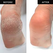 A callus is an area of thick skin. Best Foot Callus Removal Singapore Ning Spa Jewel Changi