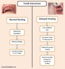 Tooth Extraction Aftercare Tooth Extraction Aftercare Tooth Extraction Care Dentistry