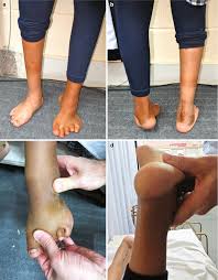 At my feet by tonia. Algorithm For Neglected Clubfoot And Residual Deformities Following Treatment Springerlink