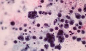 Do you know how cervical cancer can be prevented? Cervical Cancer Rates Show A Steep Rise Among Women In Their Late 20s Charity Warns Daily Mail Online