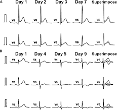 Image result for Early Repolarization