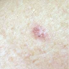 If it's not treated early, it may spread to other parts of the body. Basal Cell Carcinoma Pictures Skinvision