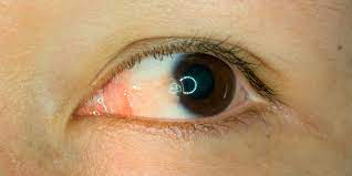 Da brukes i stedet tappene for å se detaljer og farger i dagslys. Kul Utvekst Eller Forandring Pa Det Hvite I Oyet Hva Kan Det Vaere Lommelegen