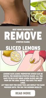 Best Home Remedies To Remove Stretch Marks Stretch Mark Removal Stretch Marks Stretch Mark Remedies