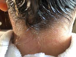 San Diego California Head Lice Treatment Mobile In Home Removal Service Licedoctors