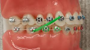 Elastics / rubber bandsin this video, i will be answer the question of what are elastics / rubber bands? and what are they used for? el. Elastics Gorton Schmohl Orthodontics Braces Colors