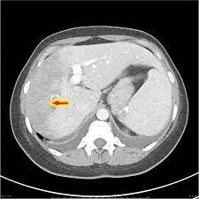 Budd Chiari Syndrome Ct Wikidoc