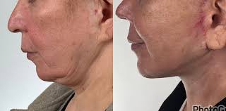 Neck lift in Ankara