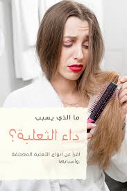 داء الثعلبة هي مصطلح طبي يستخدم بشكل عام لوصف تساقط الشعر على الرغم من أنه من الطبيعي أن يفقد الجميع عدد ا صغير ا من الشعر يومي ا إ In 2020 Alopecia Skin Care Skin