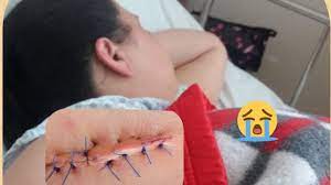 O medo da dor e decisões médicas fazem com que mais bebês nascem por cesariana embora a maioria das mulheres continuam querendo o normal. Aceitar Ou Nao O Corte No Parto Normal Como Tratar Os Pontos Me Deram Anestesia Youtube