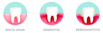 Que es la enfermedad     periodontal