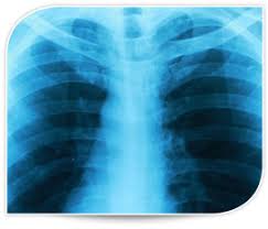 In view of the low prevalence of diffuse pleural thickening, this disease was not . Asbestosis Symptoms Diagnosis Treatment Support Amaa