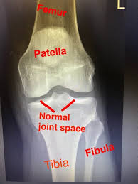Image result for Knee XRay