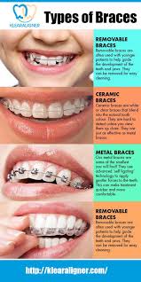 Types Of Invisible Braces In 2020 Dental Braces Ceramic Braces Braces Tips