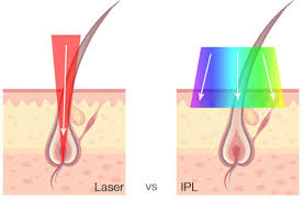 Ipl hair removal devices have a wider range of potential applications, and are effective for people with a broader variety of darker skin tones and lighter hair. Confused Between True Laser Hair Removal And Light Based Procedures No Need To Stress We Ll Help You Decide Wembley Clinic