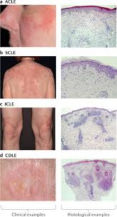 Hay varios tipos de lupus: Cutaneous Lupus Erythematosus New Insights Into Pathogenesis And Therapeutic Strategies Nature Reviews Rheumatology