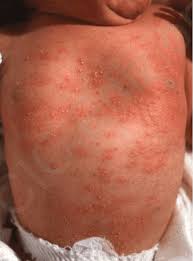 Image result for sweat rash on back baby