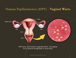 Image result for human papillomavirus symptoms