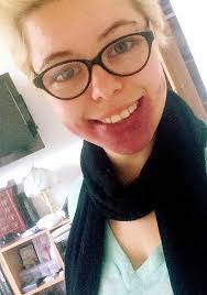 Girl whose lips never stop growing