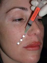 Image result for Local Skin Anesthesia