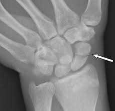 Image result for Scaphoid Fracture Signs