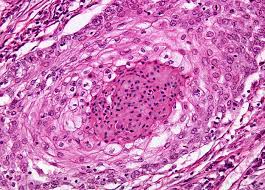 Under a microscope, the tissue sample of a nevoid melanoma will strongly resemble that of a benign mole. Squamous Cell Carcinoma At 20x Magnification Nikon S Microscopyu