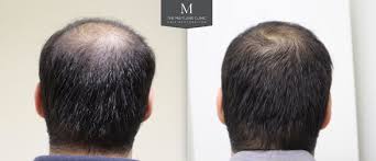 Not only is this amino acid the primary ingredient needed for hair growth. How Many Prp Treatments Are Needed For Hair Growth Answered