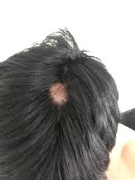 I Have A Bald Spot Appearing On My Head No One In My Genetics Is Susceptible To Baldness So Im Kind Of Freaking Out Can This Be Bald Spot Balding Appearance