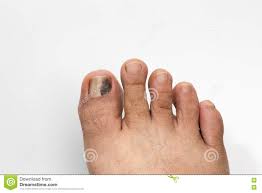Um tropeção ou bater com um dedo em alguma coisa são alguns dos acidentes que. Unha Do Pe Preta E Ferida No Branco Foto De Stock Imagem De Nomes Acidente 77744758
