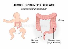Image result for Megacolon