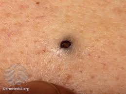 You can only use sugar, or you can mix. Comedonal Acne Symptoms Causes Treatment Prevention