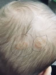 Image result for sores on the head in children