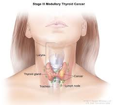 Recognize your risk for throat cancer. Endocrine Surgery Thyroid Cancer
