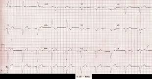 Super angebote für pacemaker f80 hier im preisvergleich. Ecg Filter Settings And Detection Of Pacemaker Spikes
