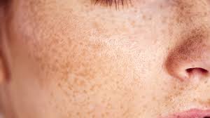 Image result for Macule