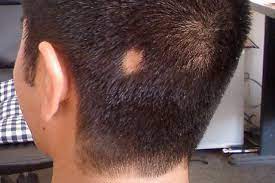 Another familiar ingredient in kitchen which also contains a large amount of sulfur is garlic. Natural Treatments For Alopecia Areata