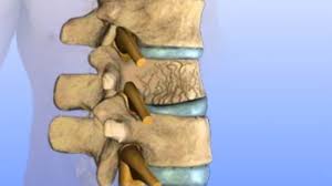 Image result for Vertebral Compression Fracture