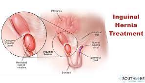 Inguinal Hernia- Cause, Diagnosis, Surgery & Recovery | Southlake Texas