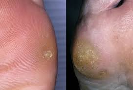 We did not find results for: Corns And Calluses Picture Image On Medicinenet Com