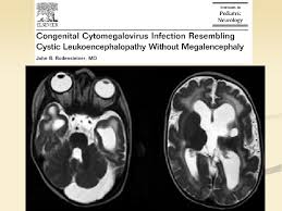 Mri studies are abnormal in the majority of children, demonstrating white and/or grey matter involvement not restricted to a particular vascular territory (see fig. Cystic Leukodystrophies M R Ashrafi Professor Of Pediatric