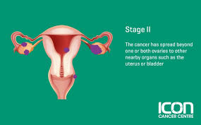 Eggs are produced in the ovaries. What Is Ovarian Cancer Ovarian Cancer Explained Icon Cancer Centre