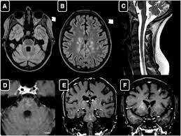 Mini pathria and jennifer bradshaw. Clippers Like Mri Findings In A Patient With Multiple Sclerosis Journal Of The Neurological Sciences