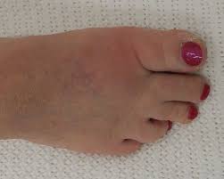 Cauzele gutei simptomele gutei diagnosticul de guta stadiile gutei tratamentul gutei iata cele mai bune remedii naturale pentru guta! Singuratatea Alergatorului De Cursa Lunga 5 Luni 88 Kg Si Guta Iceworld Deuteriumcore