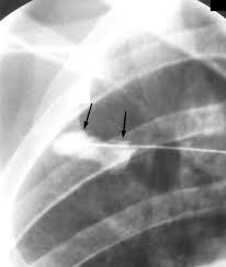 Image result for Scapulothoracic Injection