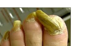Image result for Onychogryphosis feet