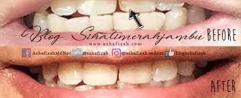 Cari tahu arti mimpi gigi copot menurut pandangan tradisional, psikologi, hingga pandangan islam yuk! Buat Tampalan Baru Gigi Depan Fraction Blog Sihatimerahjambu