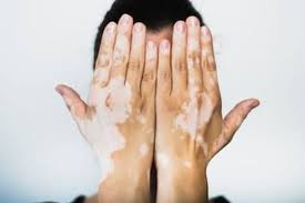 We did not find results for: Waspada Vitiligo Kelainan Pigmen Warna Pada Kulit Halaman All Kompas Com