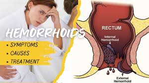 Image result for Hemorrhoid