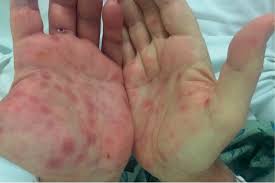 Hepatitis a, b, and c are viral infections that together affect an estimated 5% to 6% of americans. Case Of Syphilitic Hepatitis In 67 Year Old Male Patient
