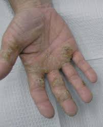Dermatitis De Manos Actas Dermo Sifiliograficas